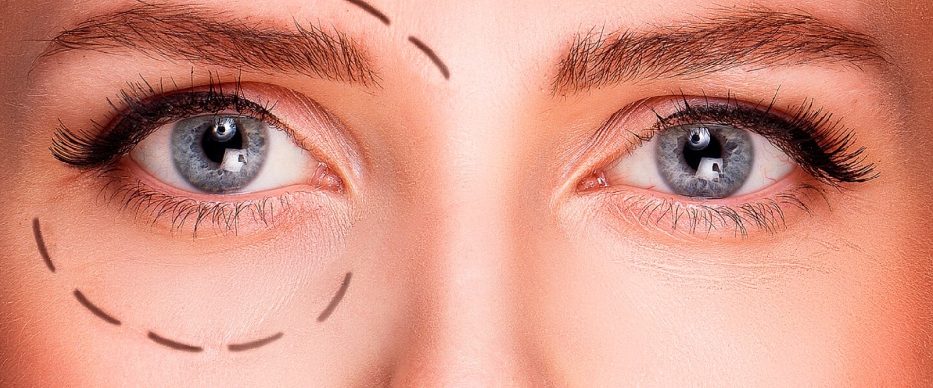 Will Botox Help Sagging Eyelids?