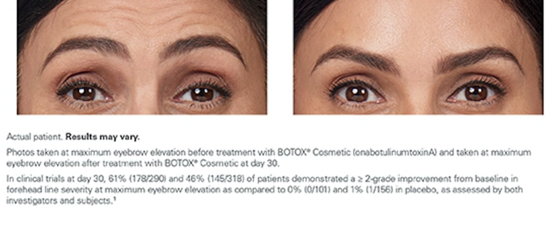 Botox and Fillers of Beverly Hills: Premium Botox Injections