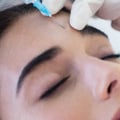 What is Botox and How Does it Work?