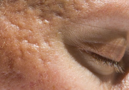 Can Botox Help Treat Acne?