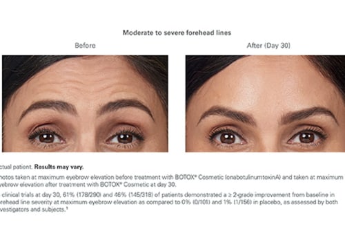 Botox and Fillers of Beverly Hills: Premium Botox Injections